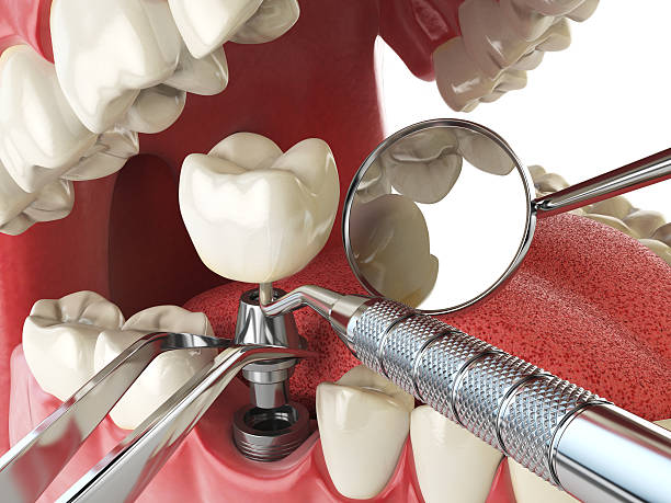 Best Emergency Tooth Extraction in Mason, TX